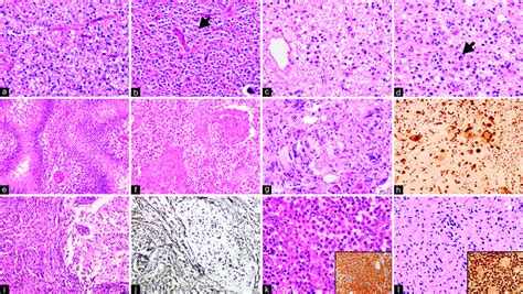 Pictomicrographs depict (a) oligodendroglioma (II), (b) anaplastic... | Download Scientific Diagram