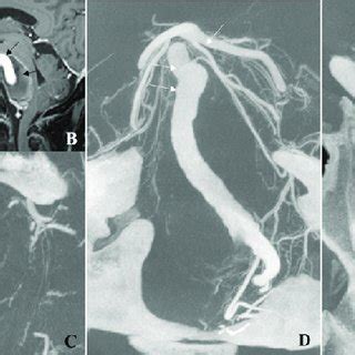 (A) Axial T2-weighted image demonstrating a large vertebrobasilar... | Download Scientific Diagram