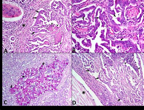 Bronchioloalveolar Carcinoma (BAC) mixed subtype, lung, feline. (A) The... | Download High ...