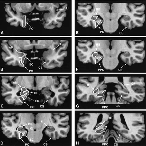 (PDF) Mesial temporal damage in temporal lobe epilepsy: A volumetric MRI study of the ...