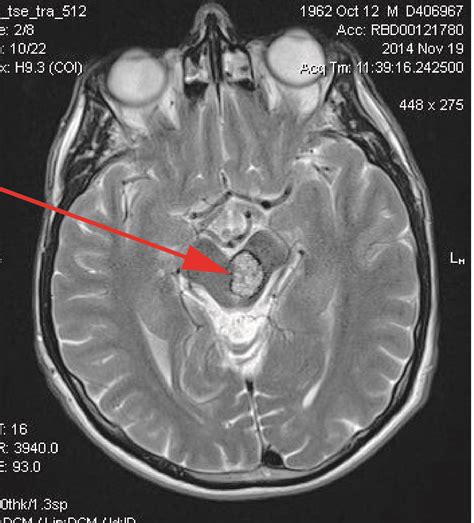 What is a cavernoma - Cavernoma Alliance UK (CAUK)