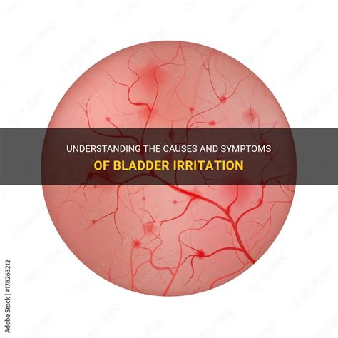 Understanding The Causes And Symptoms Of Bladder Irritation | MedShun