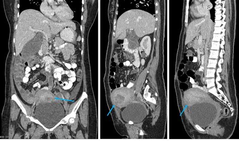 Renal milk of calcium – Radiology Cases