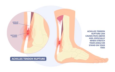 Achilles-tendon-rupture - Orthopedic & Sports Medicine