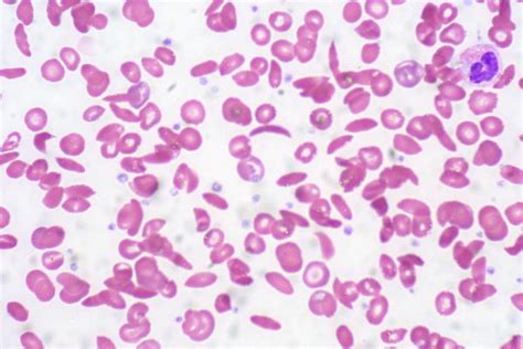 Causas de Hemoglobina Baja - Síntomas, Tratamiento y Consecuencias