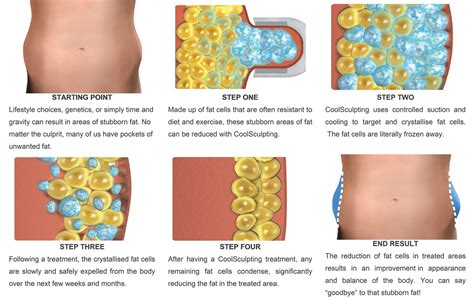 Sydney CoolSculpting - Information on Body Contouring