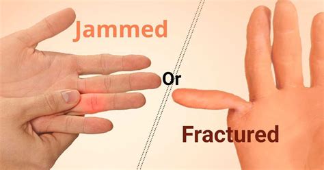 Jammed Finger Injuries