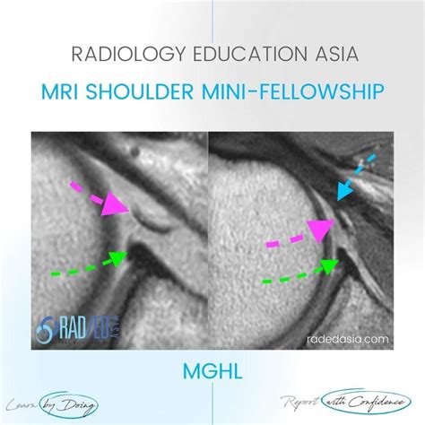 SHOULDER MRI MIDDLE GLENO HUMERAL LIGAMENT - Radedasia