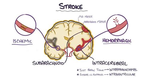 Intracerebral hemorrhage: Video, Anatomy & Definition | Osmosis