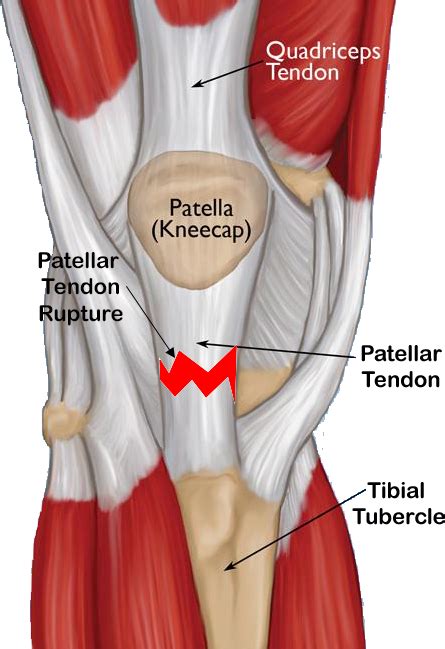 Patellar Tendon Rupture Repair