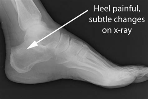 Stress Fracture - Drwolgin