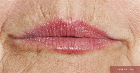 Lip wrinkle solutions | Dr. Kreymerman, Holly Springs, NC