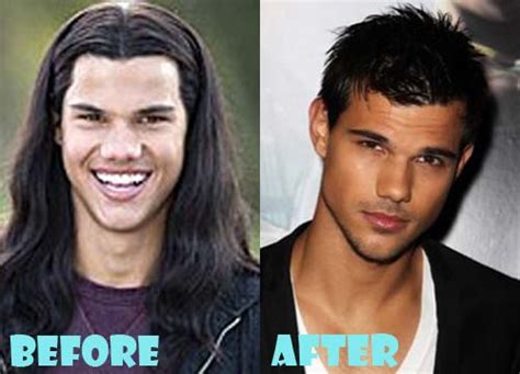 Taylor Lautner Plastic Surgery Before and After Nose Job