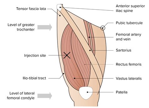 Vastus Lateralis Injection