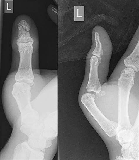 Anteroposterior and lateral X-rays of the left thumb showing volar... | Download Scientific Diagram