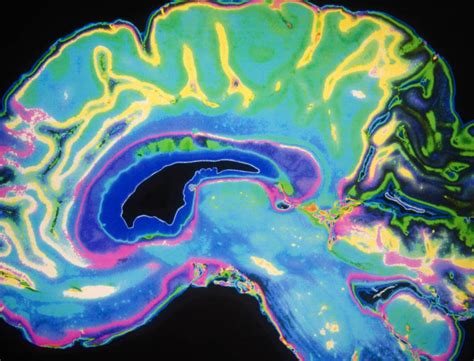 Are There Side Effects from MRI Contrast Dyes? | goop