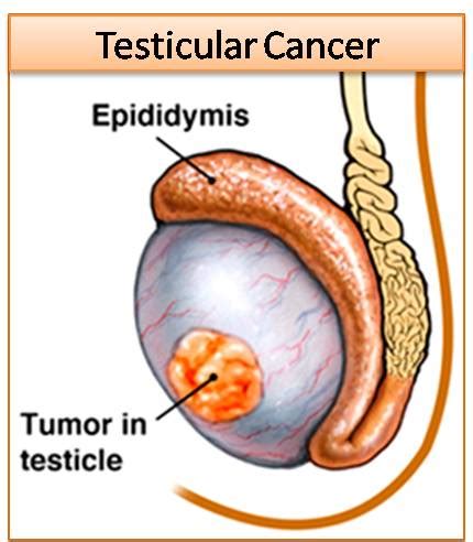 Testicular Cancer: Symptoms, Treatment, Testicular Self Examination