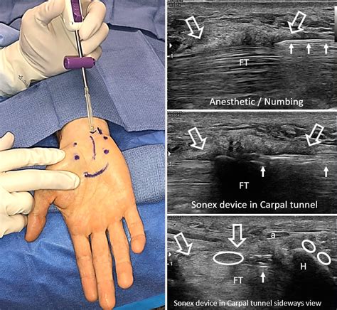 Carpal Tunnel Syndrome | USG Carpal Tunnel Release - Diagnosis & Treatment - ESPMedicine