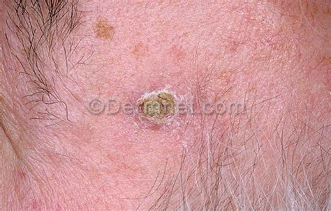 Squamous Cell Carcinoma Face Photo - Skin Disease Pictures