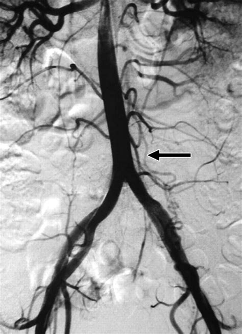 Frequency and Extent of Uterine Perfusion via Ovarian Arteries Observed ...