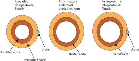 Retroperitoneal fibrosis - The Lancet