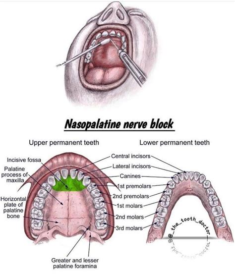 Nasopalatine nerve block - MEDizzy