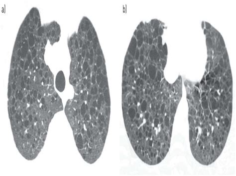 Cystic Lung Diseases