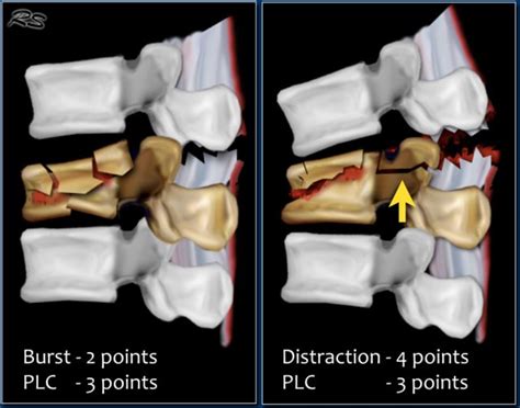 Compression Fracture Diagram