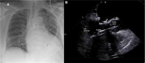 (A) Postoperative chest x-ray with Impella 5.5 pump (X outflow ...