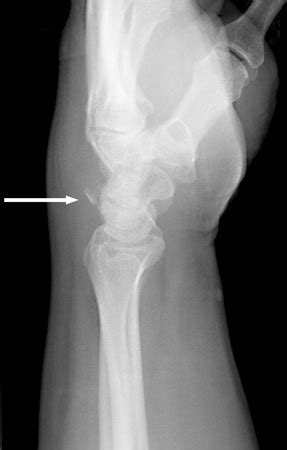 Triquetrum fracture - WikEM