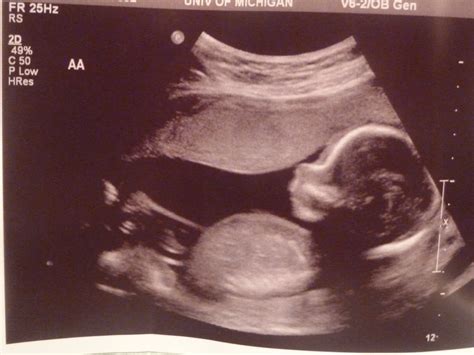 Baby Bitty Twins: 18 week ultrasound pics