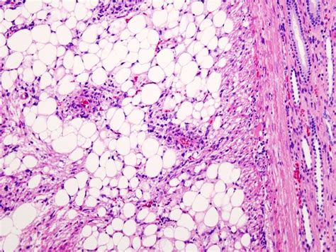 Angiomyolipoma pathophysiology - wikidoc