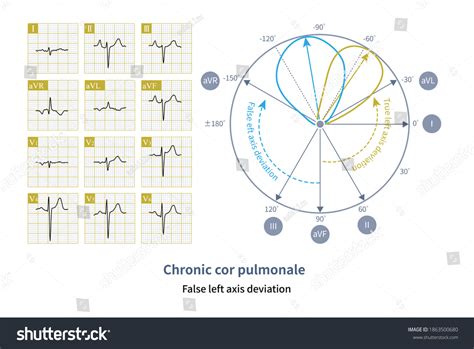 13 Cor Pulmonale Images, Stock Photos & Vectors | Shutterstock