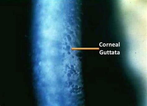 Corneal Guttata