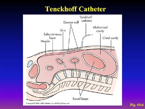 Tenckhoff Peritoneal Dialysis Catheter