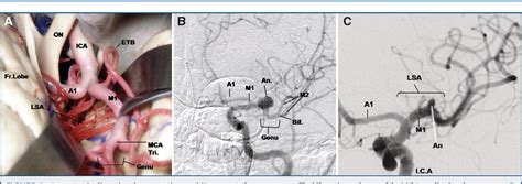 [PDF] MICROSURGICAL AND ANGIOGRAPHIC ANATOMY OF MIDDLE CEREBRAL ARTERY ...