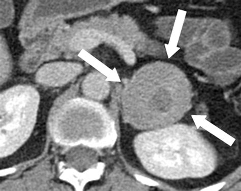 Pheochromocytoma. Causes, symptoms, treatment Pheochromocytoma