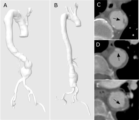 High Thoracic Tortuosity Is Associated With CT-Markers of Degeneration ...