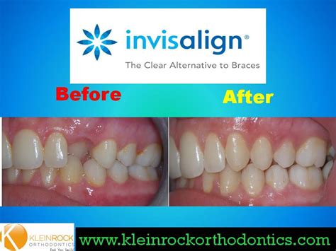 Canine crossbite treated with Invisalign | Invisalign, Braces alternative, Crossbite