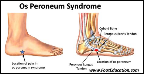 Os Peroneum Syndrome -Painful Os Peroneum - FootEducation