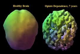 Monitoring the Human Brain | Information on How Substance Abuse Damages the Brain