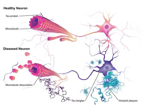 The Biology of Health: Removing Tau Protein in Alzheimer's Disease: A Potential Treatment