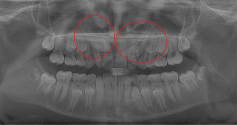 braces pulling baby teeth - Maris Walls