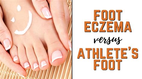 Athlete's Foot Eczema On Feet Sale Online | emergencydentistry.com