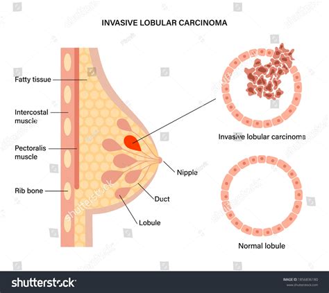 Invasive Lobular Carcinoma Photos and Images & Pictures | Shutterstock