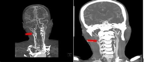 Internal Carotid Artery Ct Scan