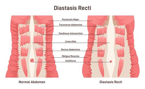 Abdominal Muscles Separation (Diastasis Recti)