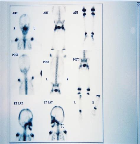 Bone scintigraphy ruled out other bone involvement | Download ...