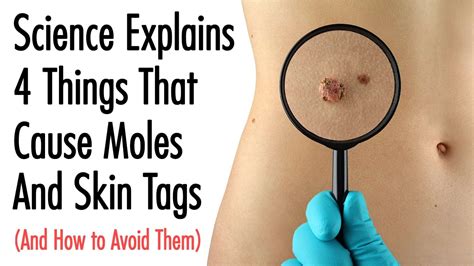 Science Explains 4 Things That Cause Moles And Skin Tags (And How to Avoid Them) | Skin tag ...