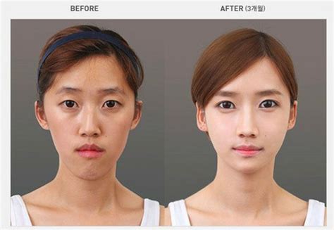 Before and After Photos of Korean Plastic Surgery. Part 2 (62 PICS ...